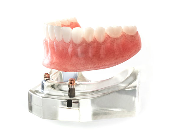 Sharp Dentistry | Ceramic Crowns, Implant Dentures and Dental Fillings
