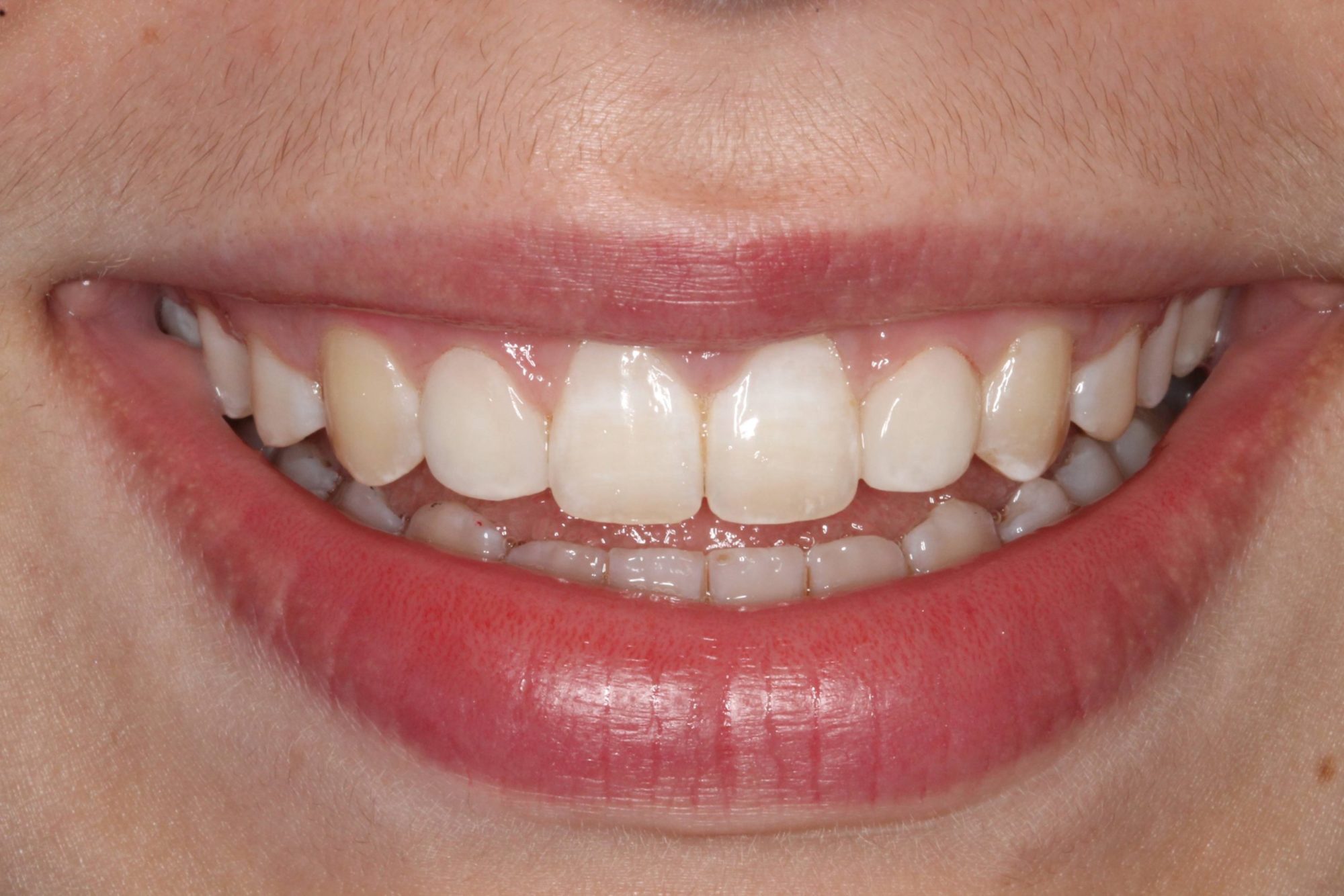 Sharp Dentistry | Inlays  amp  Onlays, Extractions and Oral Exams