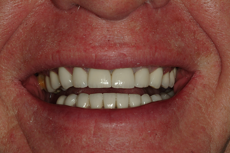 Sharp Dentistry | Inlays  amp  Onlays, Sinus Augmentation and Dentures