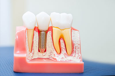 Sharp Dentistry | Sedation Dentistry, Emergency Treatment and All-on-4 reg 