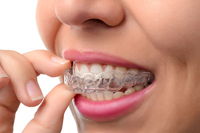 Sharp Dentistry | Dental Sealants, Inlays  amp  Onlays and Fluoride Treatment