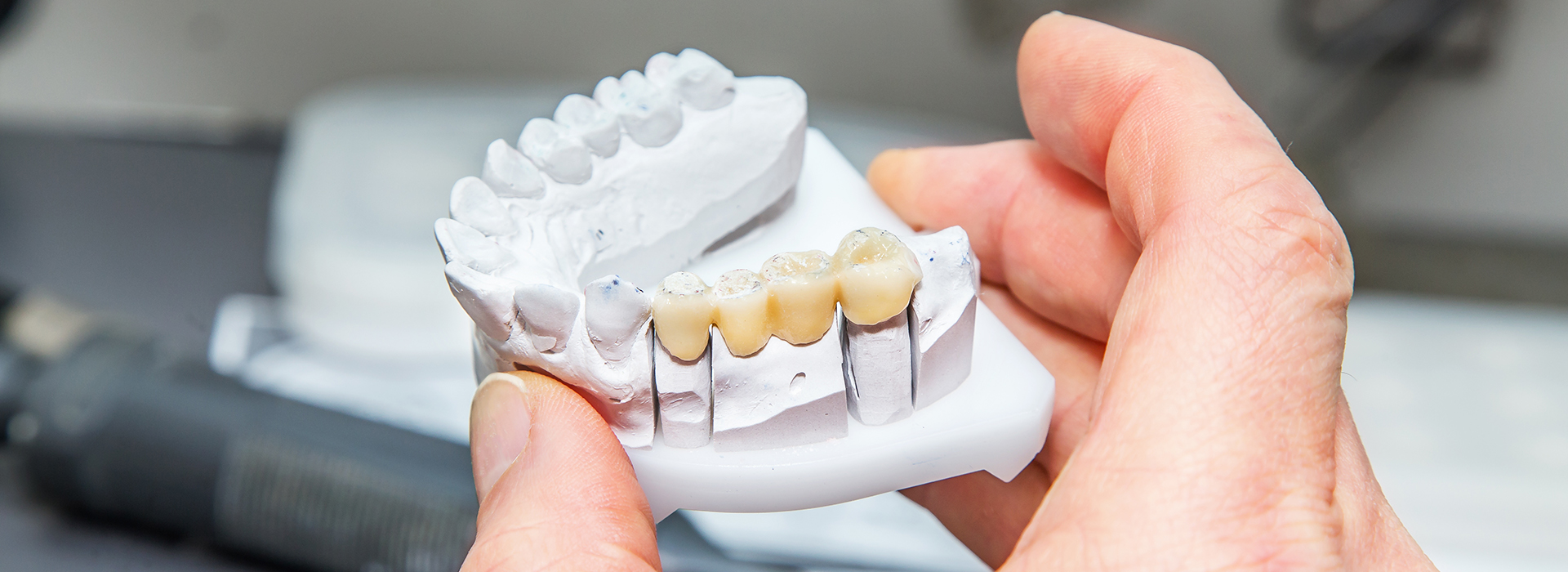 Sharp Dentistry | Teeth Whitening, All-on-6 reg  and Inlays  amp  Onlays